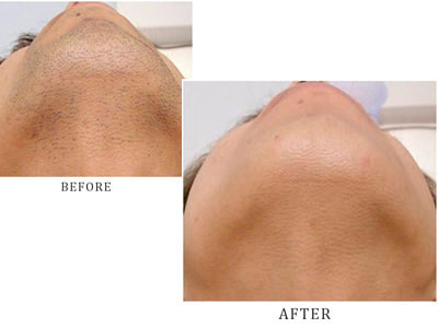 脱毛効果抜群！