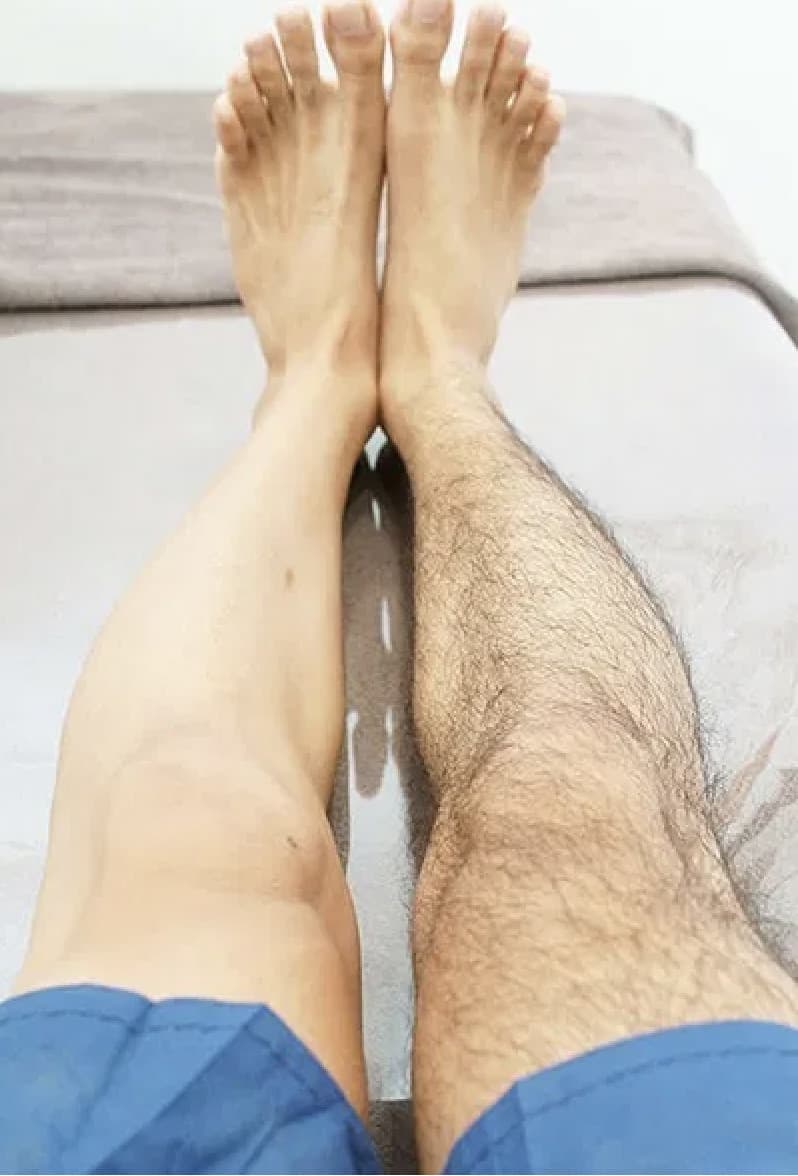 足脱毛