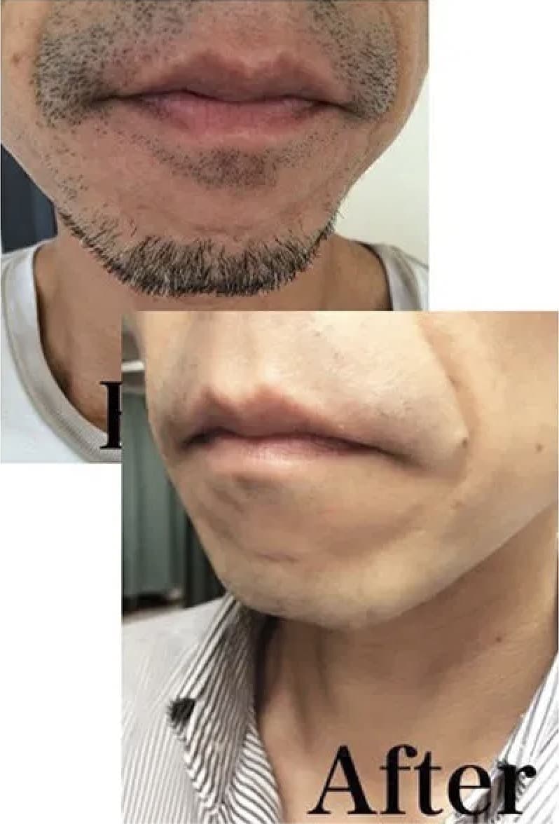 ヒゲ脱毛