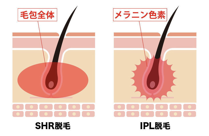 SHR脱毛・IPL脱毛