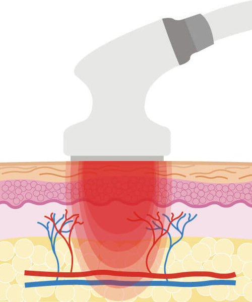 RF（ラジオ波）
