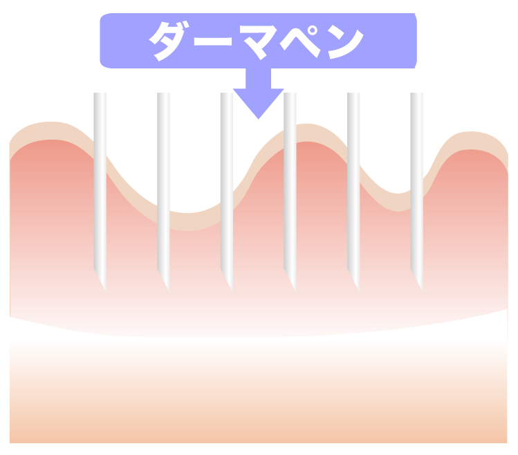 ダーマペン1