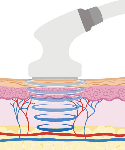 キャビテーション